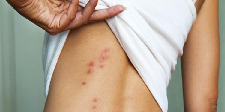 Pire ilaçlama, tahta kurusu ilaçlama